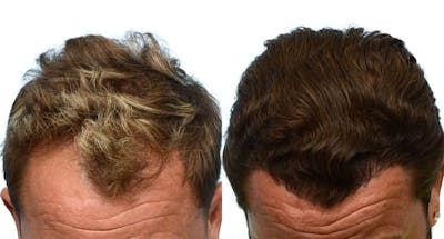 FUE Hair Transplant Before & After Gallery - Patient 525209 - Image 1