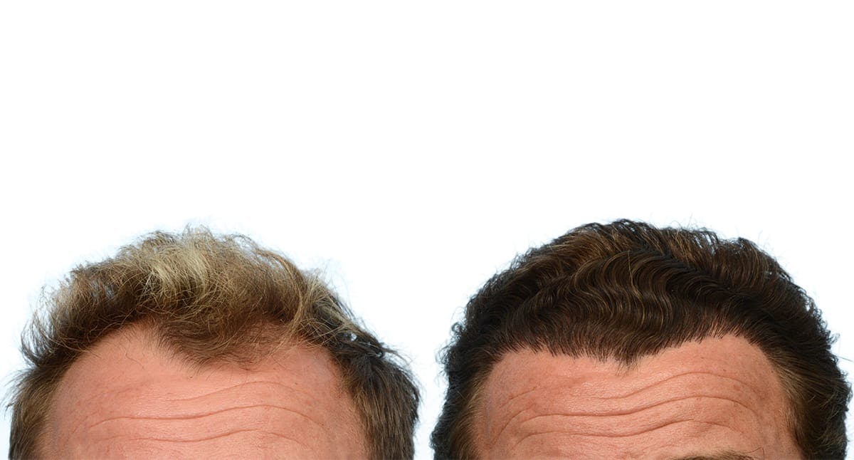 Hair Restoration Before & After Gallery - Patient 106578 - Image 2