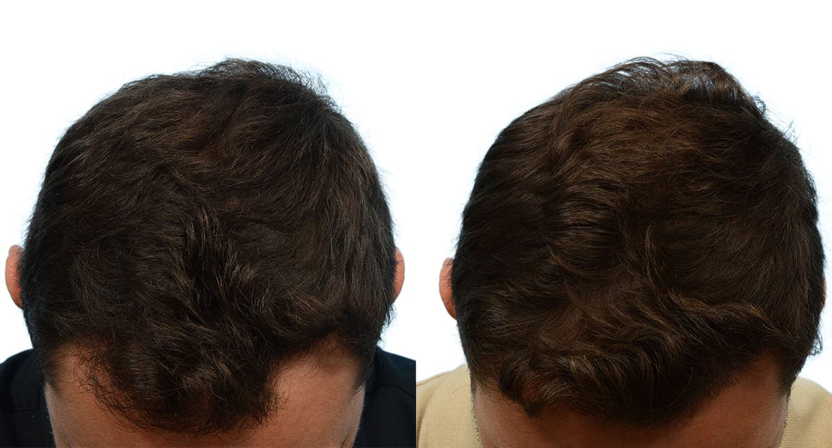 Hair Restoration Before & After Gallery - Patient 102999 - Image 1