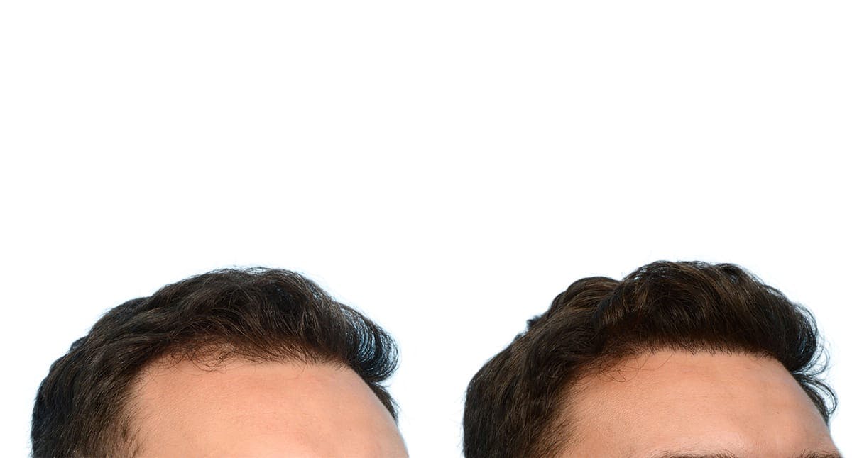 FUE Hair Transplant Before & After Gallery - Patient 249142 - Image 2
