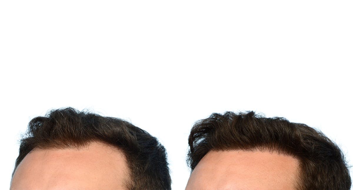 FUE Hair Transplant Before & After Gallery - Patient 249142 - Image 3