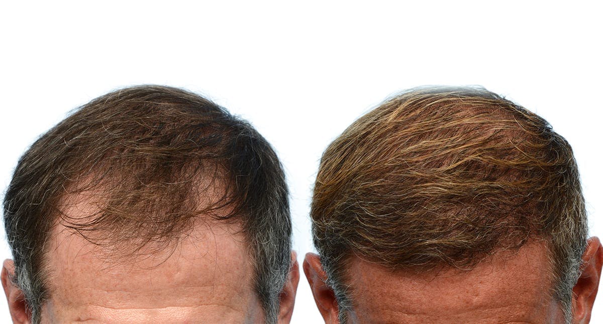 FUE Hair Transplant Before & After Gallery - Patient 292509 - Image 1