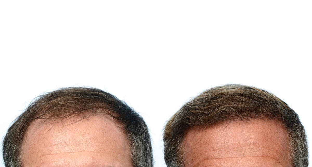 FUE Hair Transplant Before & After Gallery - Patient 292509 - Image 2