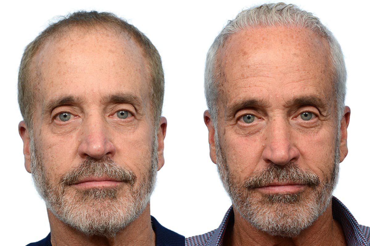 Hair Restoration Before & After Gallery - Patient 263031 - Image 2