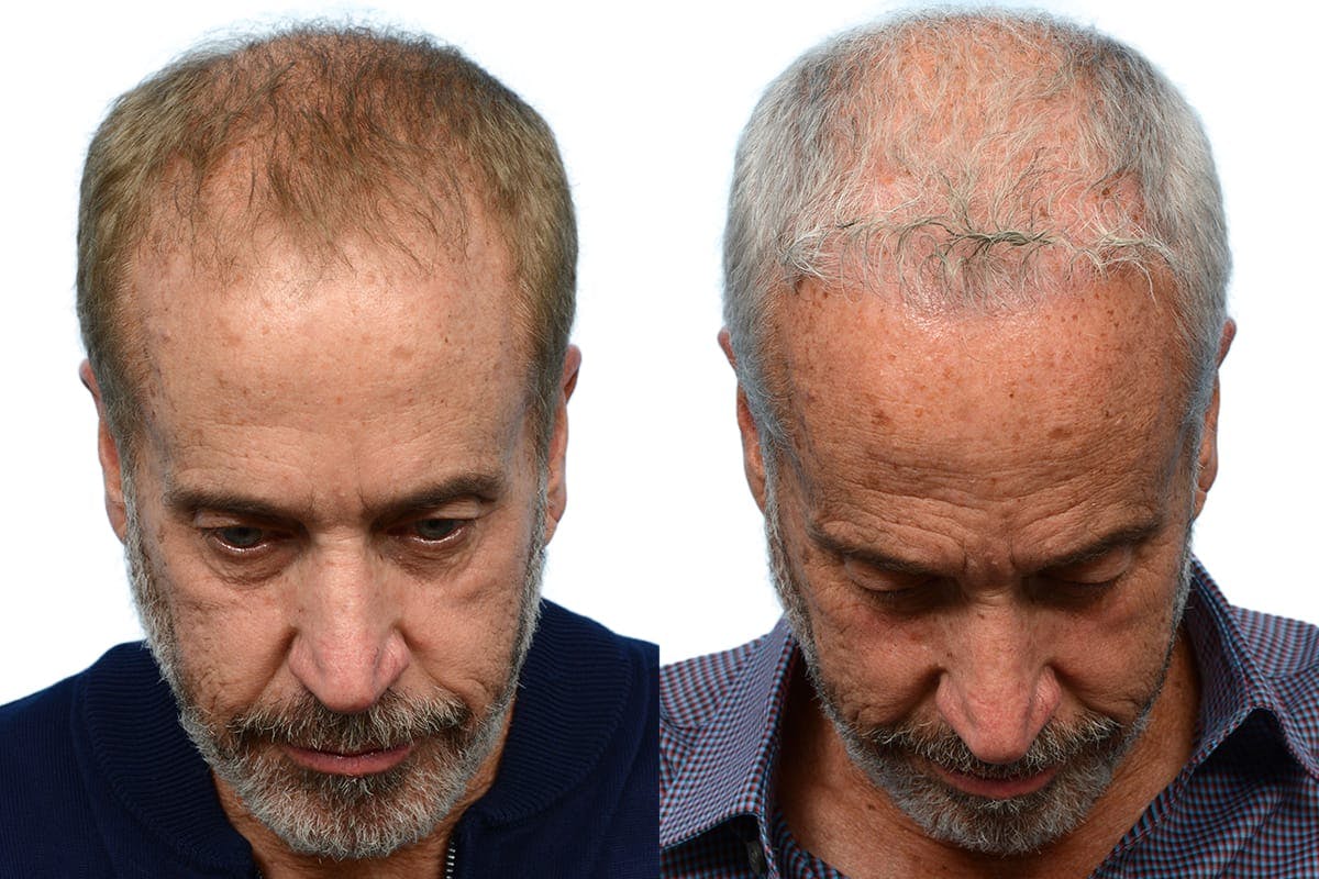 Platelet-Rich-Plasma Before & After Gallery - Patient 336639 - Image 1