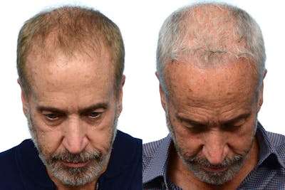 FUE Hair Transplant Before & After Gallery - Patient 397305 - Image 1