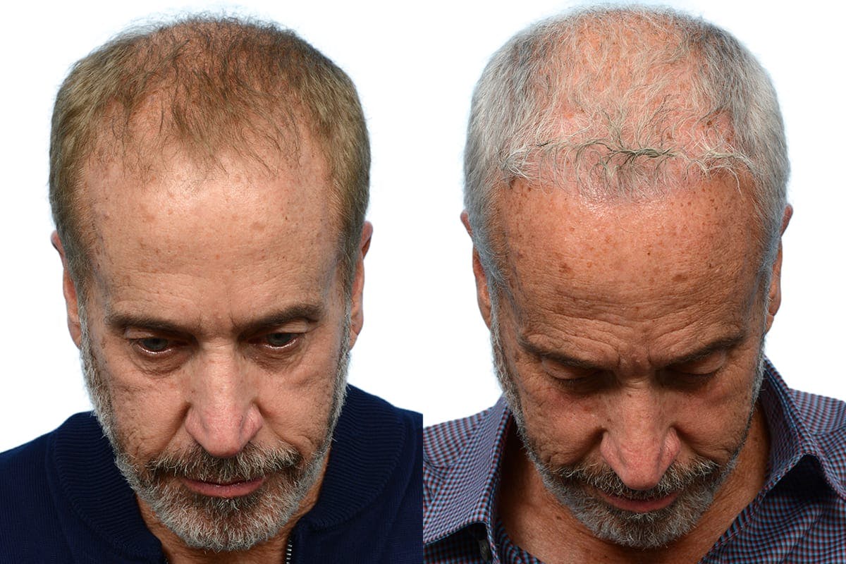 FUE Hair Transplant Before & After Gallery - Patient 397305 - Image 1