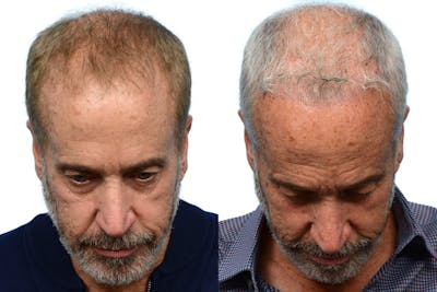 Platelet-Rich-Plasma Before & After Gallery - Patient 336639 - Image 1