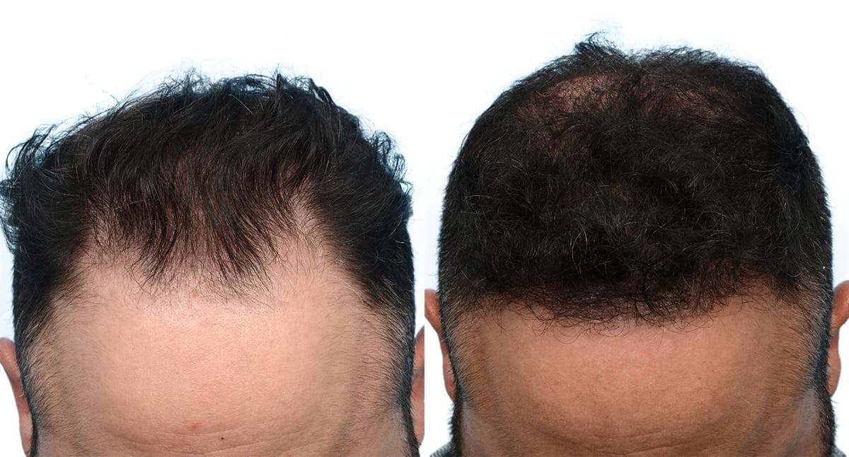 Hair Restoration Before & After Gallery - Patient 140181 - Image 1