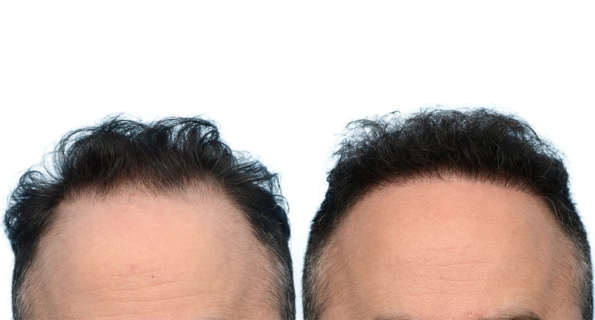 FUE Hair Transplant Before & After Gallery - Patient 385776 - Image 2