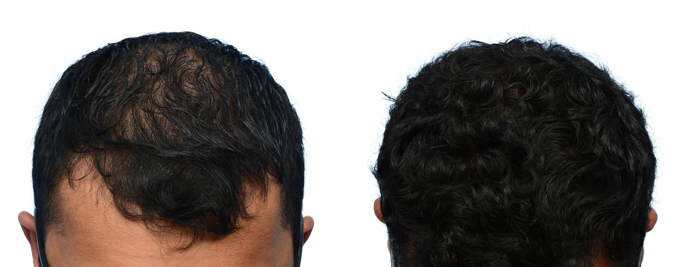 Hair Restoration  Before & After Gallery - Patient 336575 - Image 1
