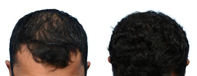 Hair Restoration Before & After Gallery - Patient 336575 - Image 1