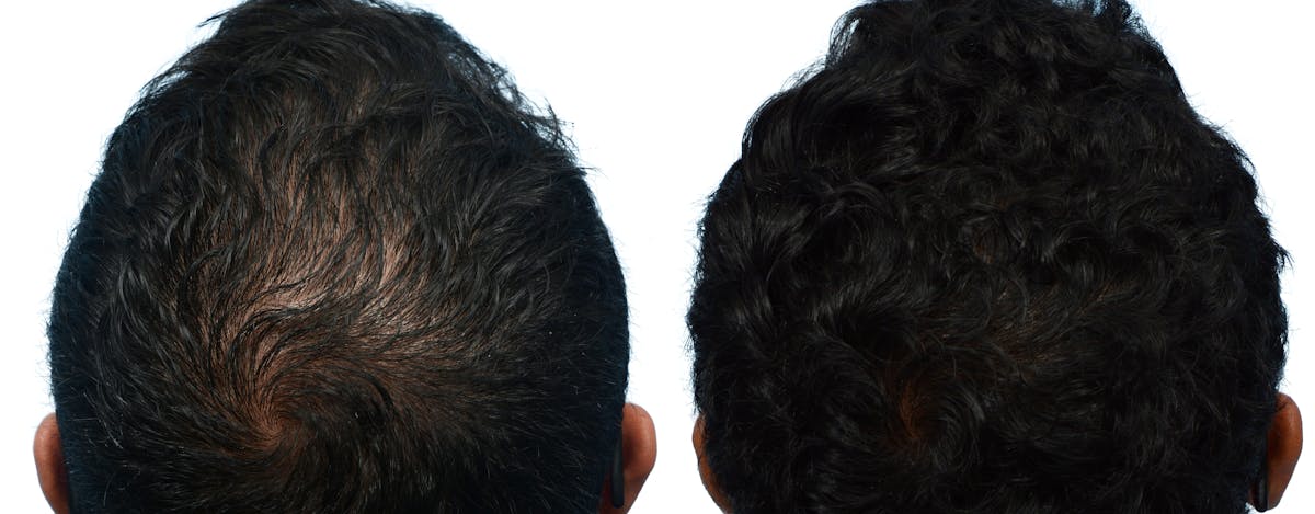 Hair Restoration Before & After Gallery - Patient 336575 - Image 2