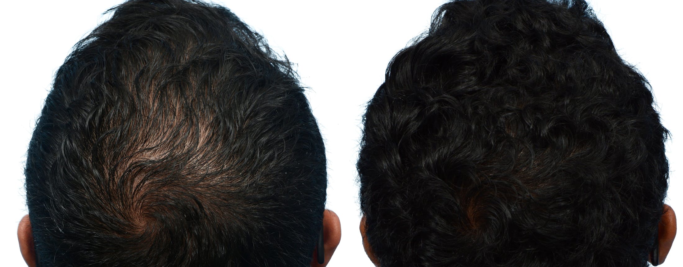 Hair Restoration  Before & After Gallery - Patient 336575 - Image 2