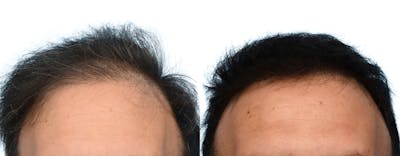 FUE Hair Transplant Before & After Gallery - Patient 100560 - Image 1