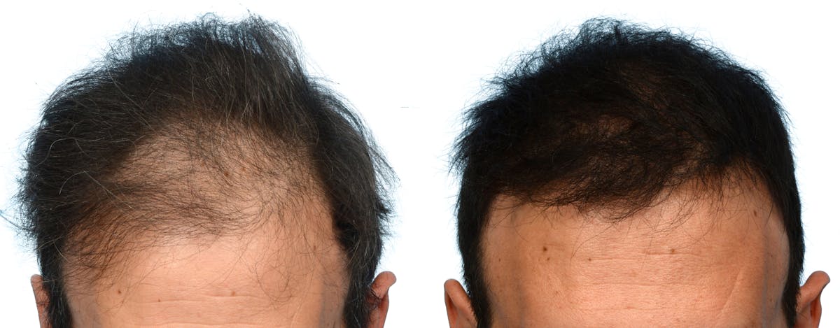 FUE Hair Transplant Before & After Gallery - Patient 100560 - Image 2
