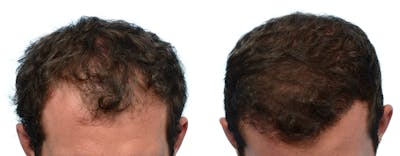 FUE Hair Transplant Before & After Gallery - Patient 114344 - Image 1