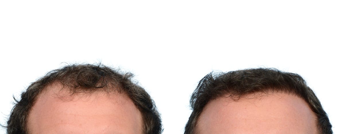 FUE Hair Transplant Before & After Gallery - Patient 114344 - Image 2