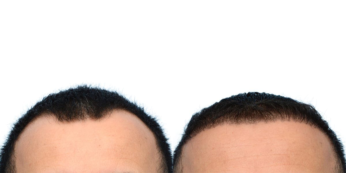 FUE Hair Transplant Before & After Gallery - Patient 371156 - Image 2