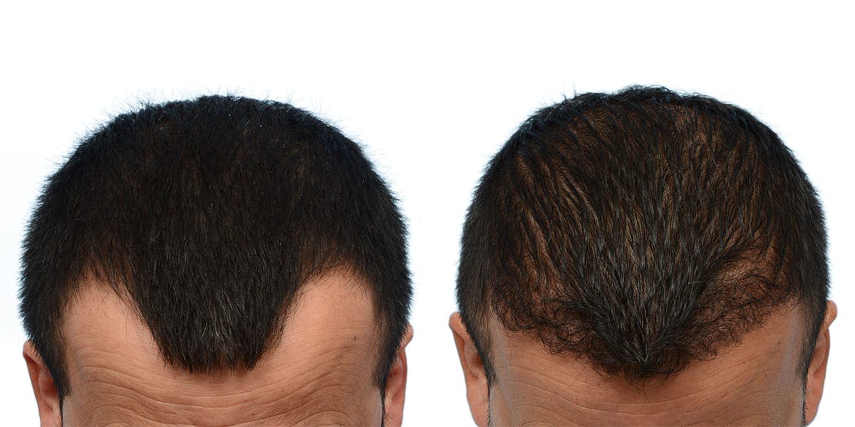 FUE Hair Transplant Before & After Gallery - Patient 371156 - Image 1