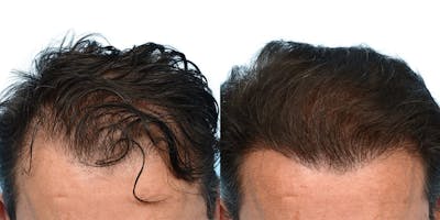 FUE Hair Transplant Before & After Gallery - Patient 408103 - Image 1