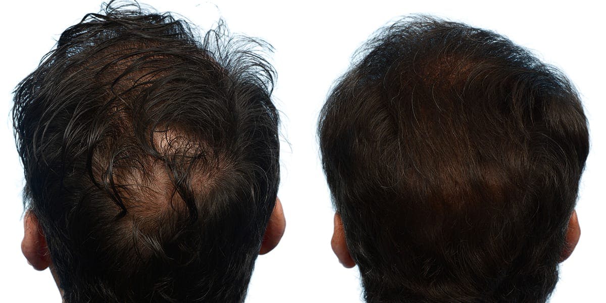 Hair Restoration Before & After Gallery - Patient 329669 - Image 2