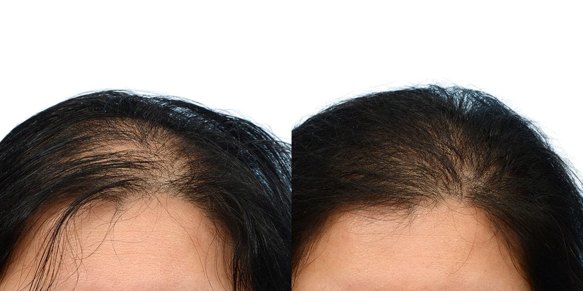 Hair Restoration Before & After Gallery - Patient 145911 - Image 1