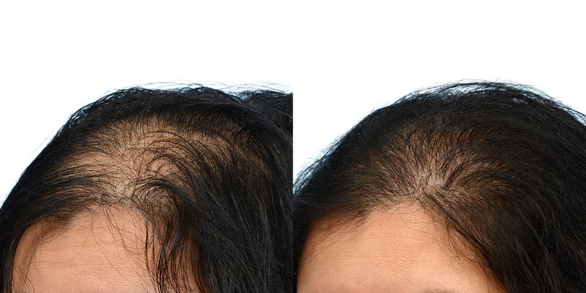 Hair Restoration Before & After Gallery - Patient 145911 - Image 2