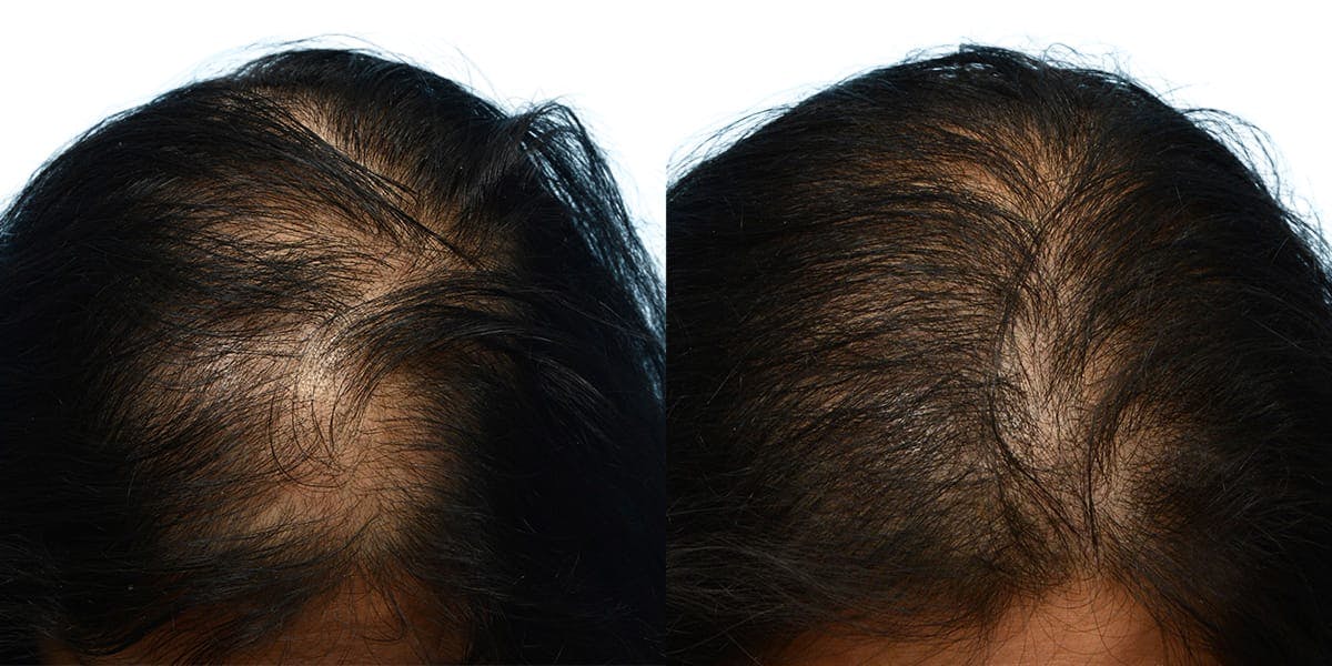 Hair Restoration Before & After Gallery - Patient 145911 - Image 3