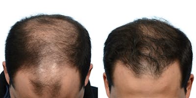 FUE Hair Transplant Before & After Gallery - Patient 164194 - Image 1