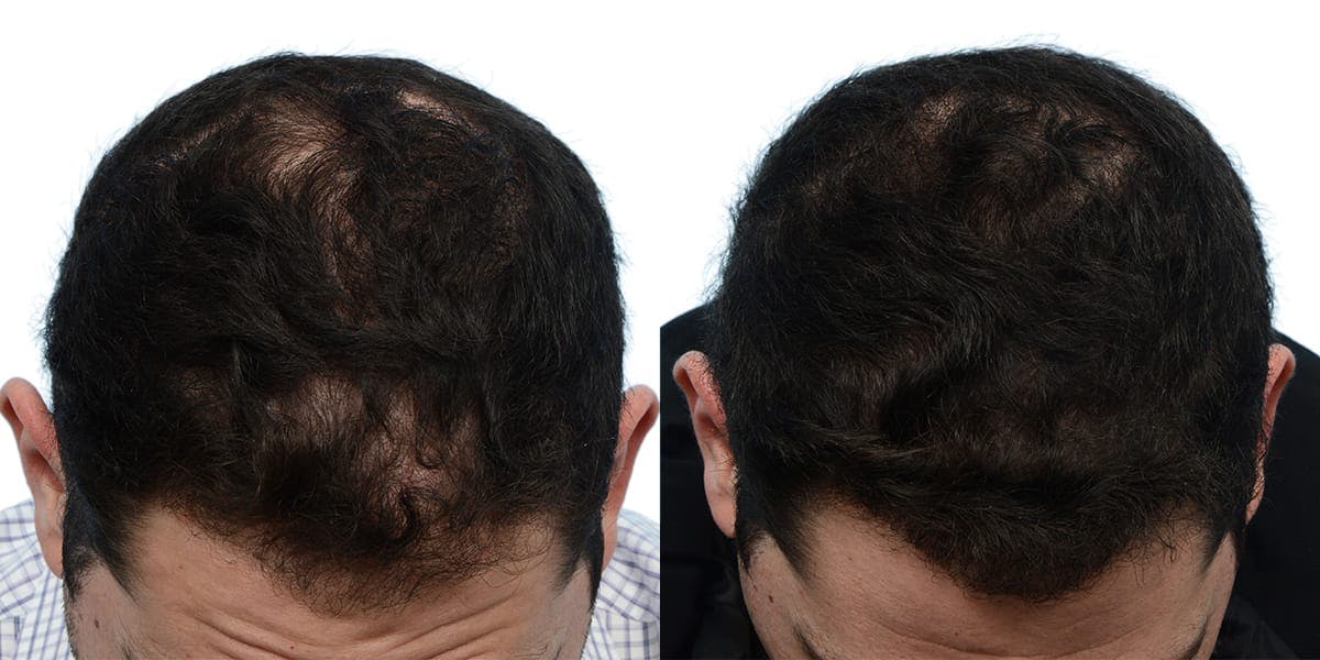FUE Hair Transplant Before & After Gallery - Patient 178028 - Image 1