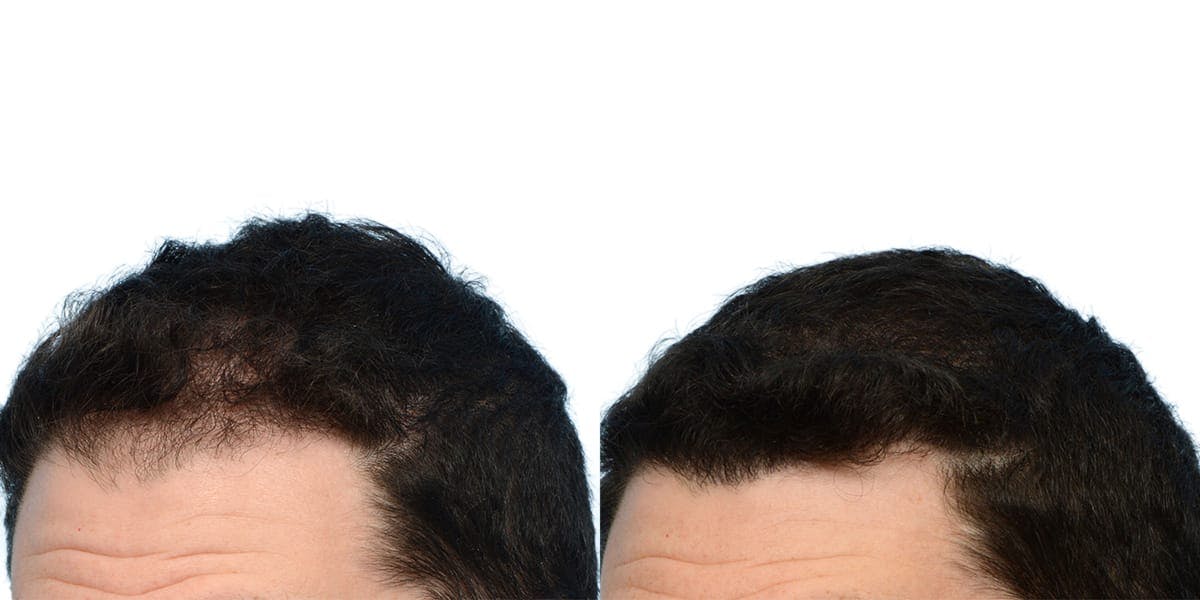 FUE Hair Transplant Before & After Gallery - Patient 178028 - Image 2
