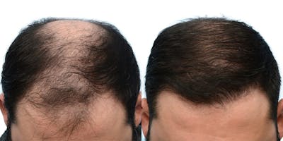 FUE Hair Transplant Before & After Gallery - Patient 338996 - Image 1