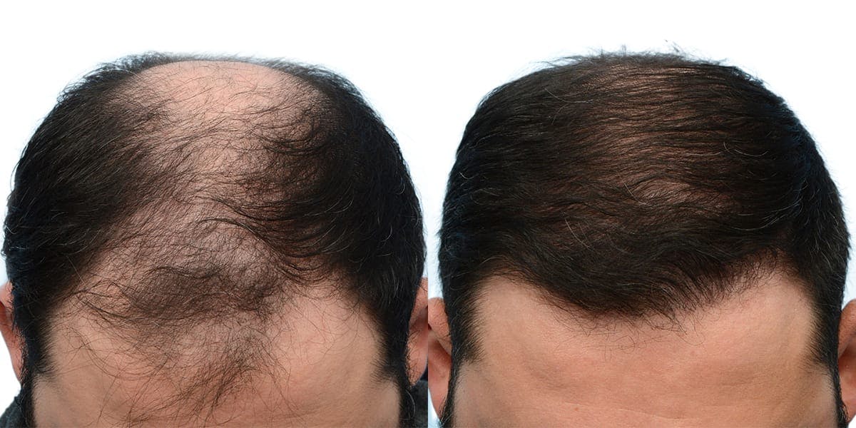 FUE Hair Transplant Before & After Gallery - Patient 338996 - Image 1