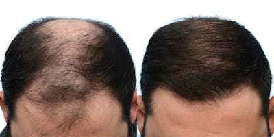 Hair Restoration Before & After Gallery - Patient 407582 - Image 1