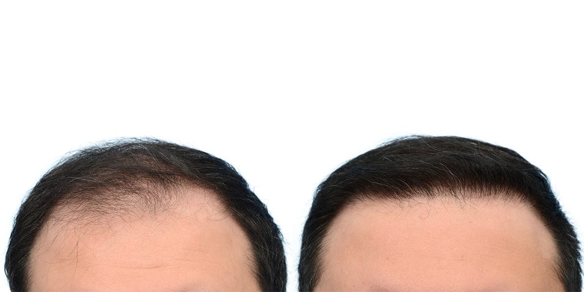 Hair Restoration Before & After Gallery - Patient 407582 - Image 2