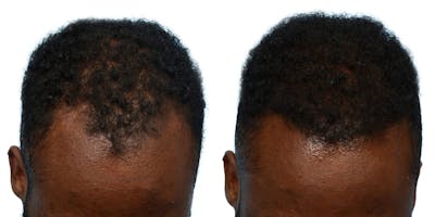 FUE Hair Transplant Before & After Gallery - Patient 435316 - Image 1