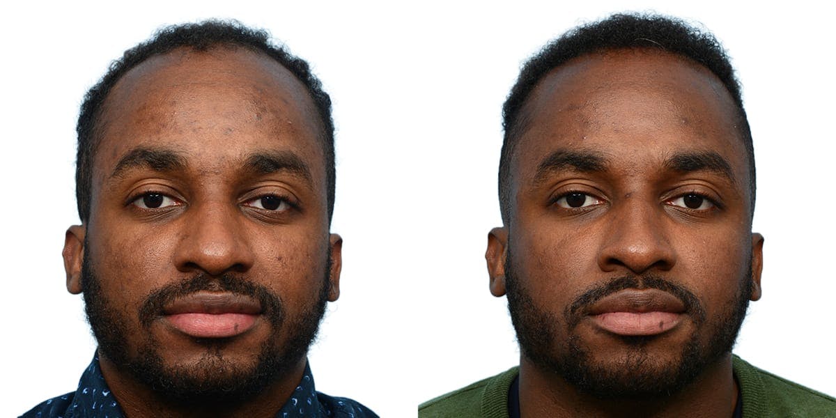 Hair Restoration Before & After Gallery - Patient 385022 - Image 2