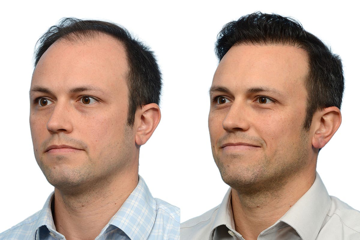 Hair Restoration Before & After Gallery - Patient 405673 - Image 4