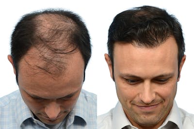 Hair Restoration Before & After Gallery - Patient 405673 - Image 1
