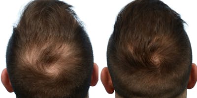 Hair Restoration Before & After Gallery - Patient 131089 - Image 1