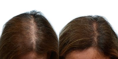 Female Hair Restoration Before & After Gallery - Patient 270716 - Image 1
