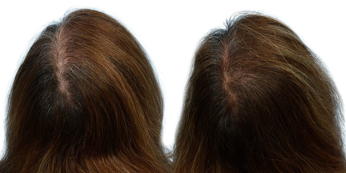 Female Hair Restoration Before & After Gallery - Patient 270716 - Image 2