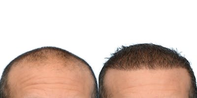 FUE Hair Transplant Before & After Gallery - Patient 400077 - Image 1