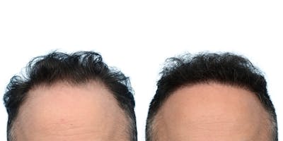 FUE Hair Transplant Before & After Gallery - Patient 335980 - Image 1