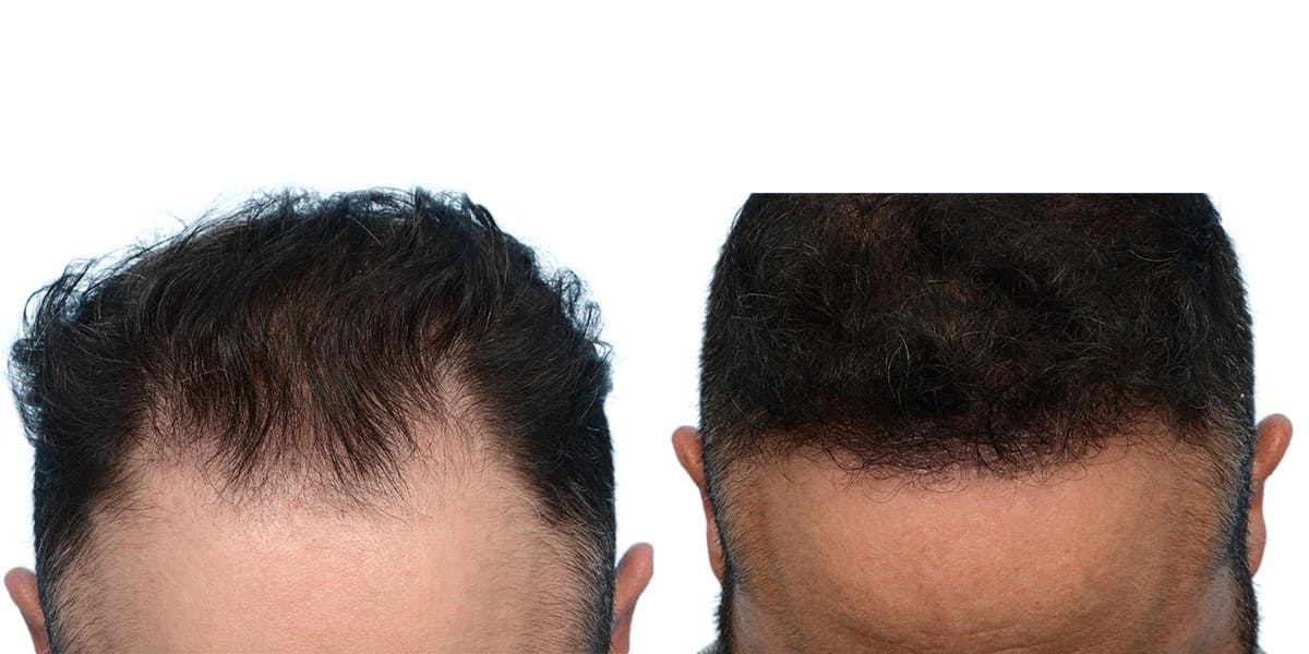 FUE Hair Transplant Before & After Gallery - Patient 335980 - Image 2
