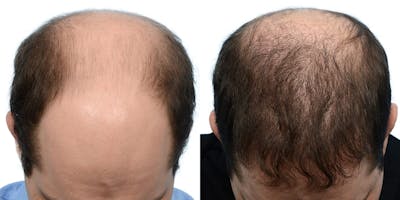 Platelet-Rich-Plasma Before & After Gallery - Patient 404221 - Image 1