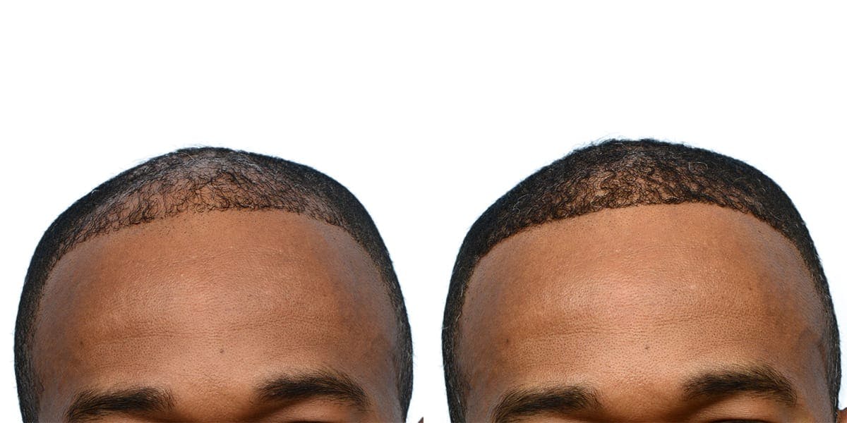 Hair Restoration Before & After Gallery - Patient 211907 - Image 1