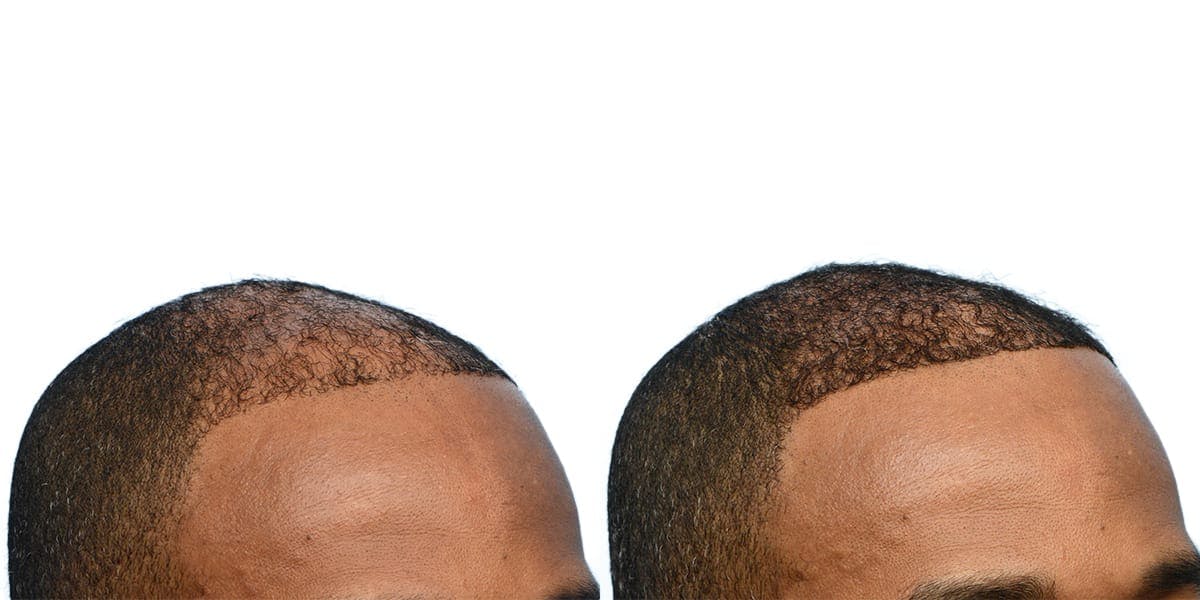 Hair Restoration Before & After Gallery - Patient 211907 - Image 2