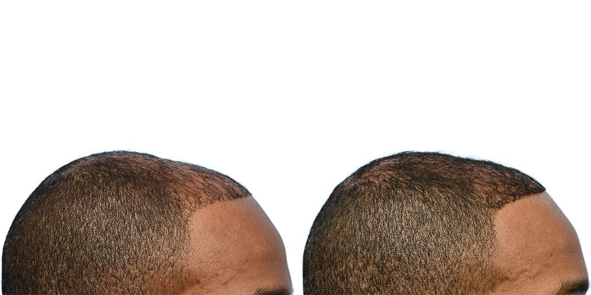 Hair Restoration Before & After Gallery - Patient 211907 - Image 3